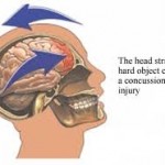 concussion signs of concussion how to prevent head injury winter sports PragmaticMom Pragmatic Mom http://PragmaticMom.com Education Matters