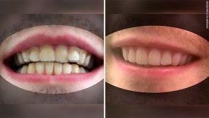 College student makes own invisalign